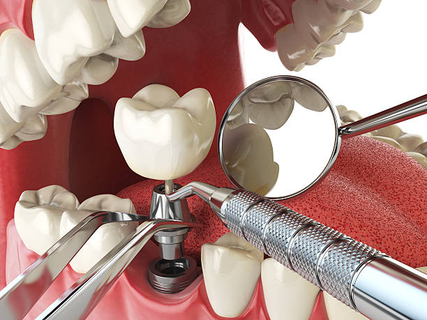 Best Broken or Cracked Tooth Emergency Dentist in Calverton, MD